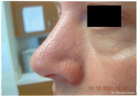 Laser For Veins And Redness: Patient 7 - After 1