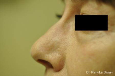 Laser: Patient 1 - After Image