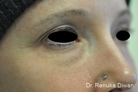 Laser Skin Resurfacing: Patient 3 - After 2