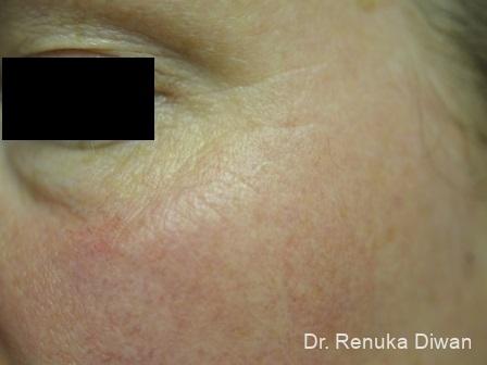 BOTOX® Cosmetic: Patient 21 - After Image