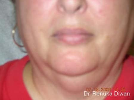 Liposuction: Patient 2 - Before 