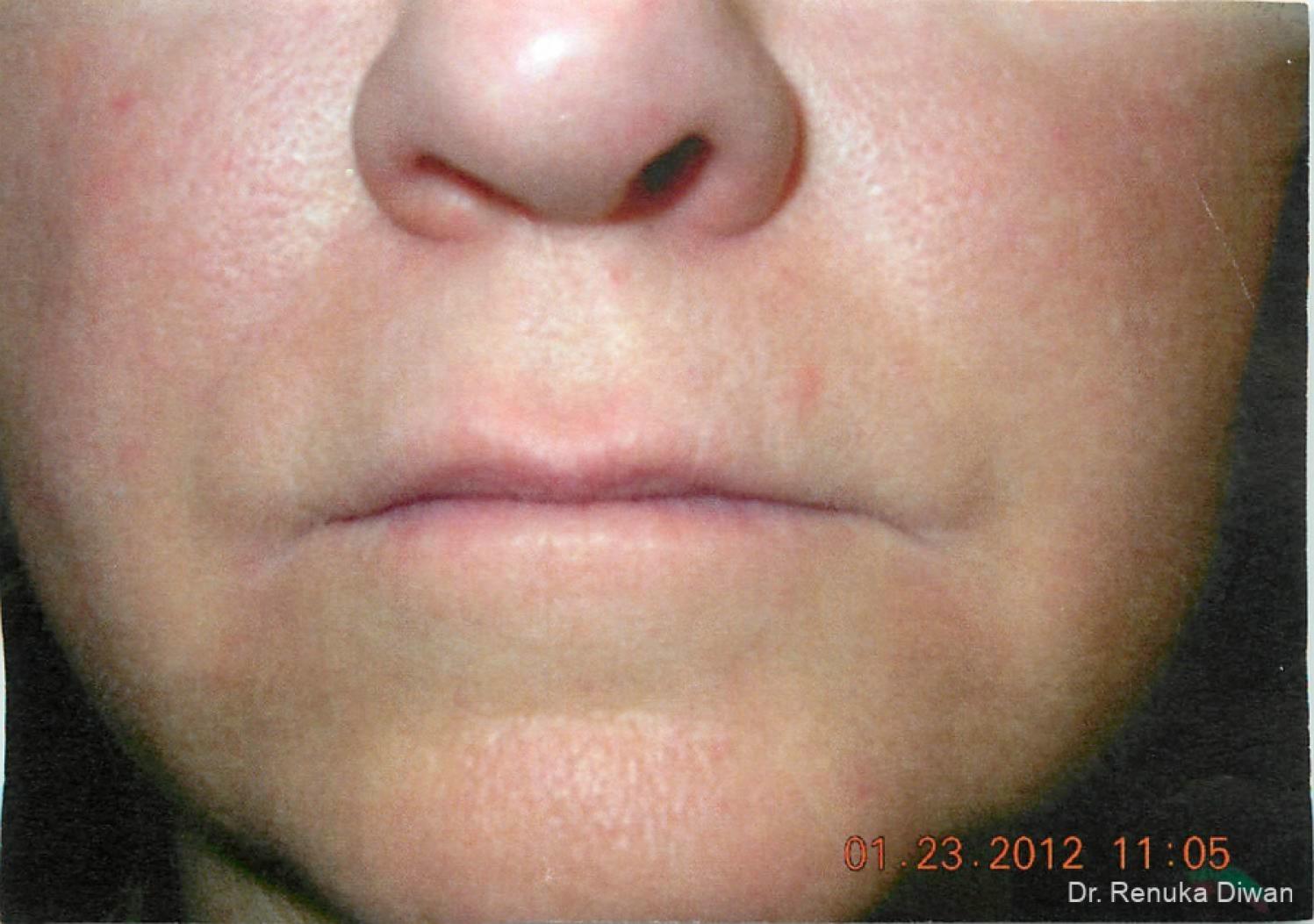 Marionette Lines: Patient 4 - After  