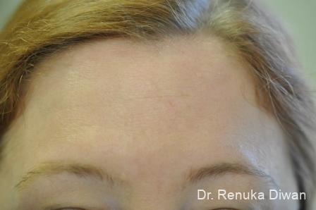 Forehead Creases: Patient 6 - After 1