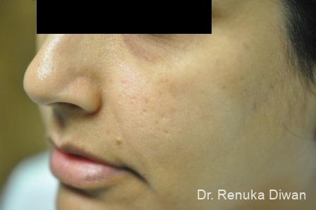 Microneedling: Patient 2 - Before 