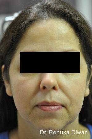 Skin Tightening: Patient 1 - Before and After 2