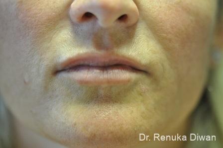 Lips And Mouth: Patient 18 - After 1