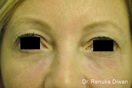 Blepharoplasty: Patient 1 - Before 