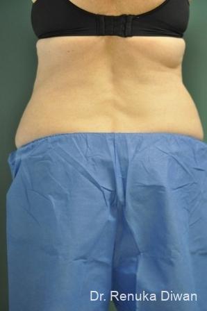 CoolSculpting®: Patient 1 - Before 