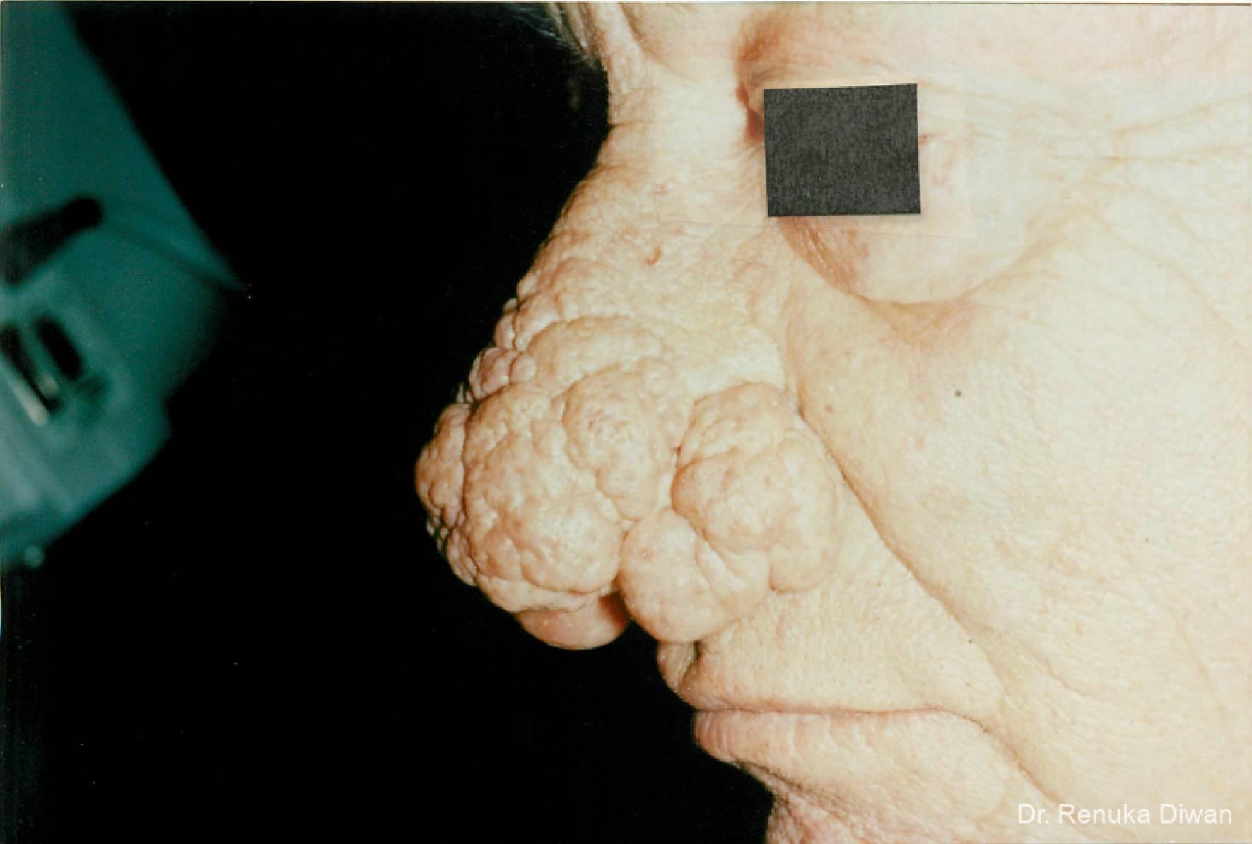 Lasers For Rhinophyma: Patient 2 - Before 1