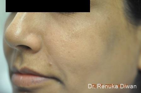Microneedling: Patient 2 - After 1