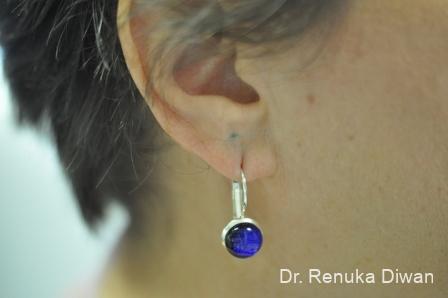 Earlobe Surgery: Patient 1 - Before and After 2