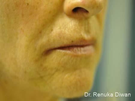 Lips And Mouth: Patient 8 - After 1