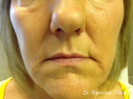 Lips And Mouth: Patient 7 - Before 1