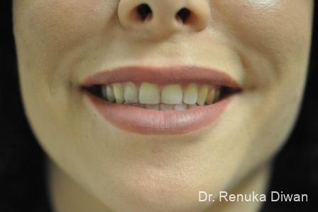 Smile Lines: Patient 10 - After  