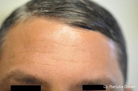 BOTOX® Cosmetic: Patient 16 - Before Image