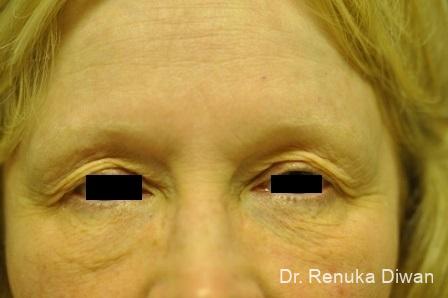 Blepharoplasty: Patient 7 - Before 