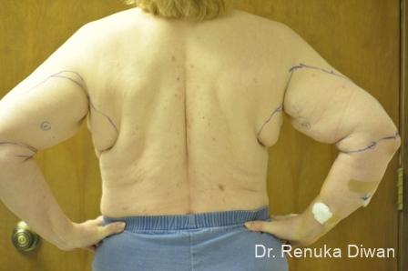 Liposuction: Patient 19 - Before and After 2