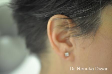 Earlobe Surgery: Patient 5 - After 2