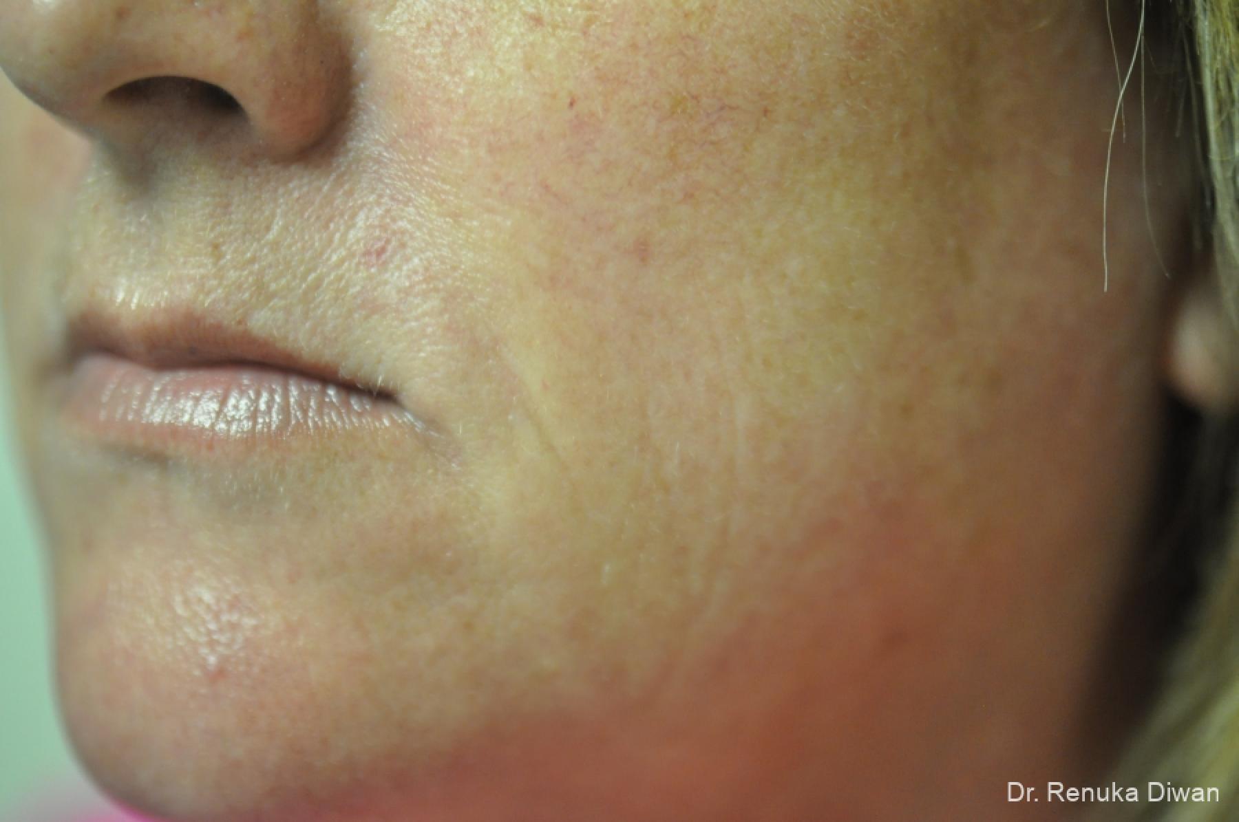 Microneedling: Patient 4 - After 2