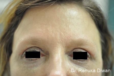 Blepharoplasty: Patient 8 - After  