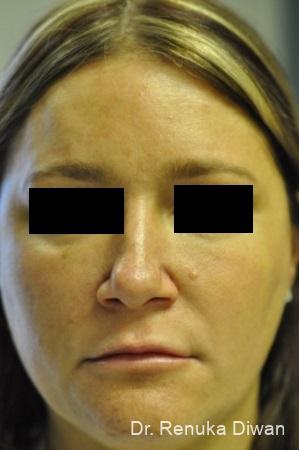 BOTOX® Cosmetic: Patient 22 - After 1