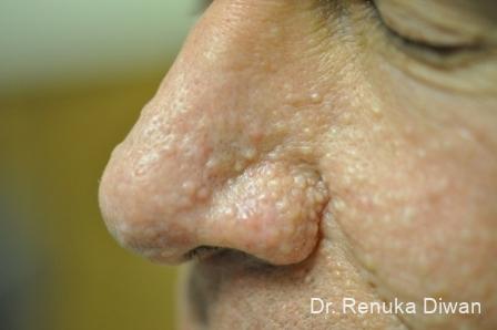 Laser-skin-resurfacing-for-men: Patient 1 - Before 