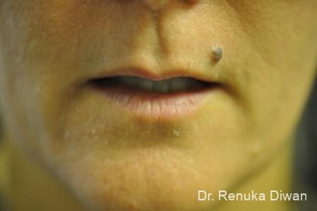 Laser For Veins And Redness: Patient 21 - After 1