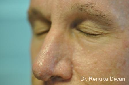 Laser Skin Resurfacing For Men: Patient 1 - After 1