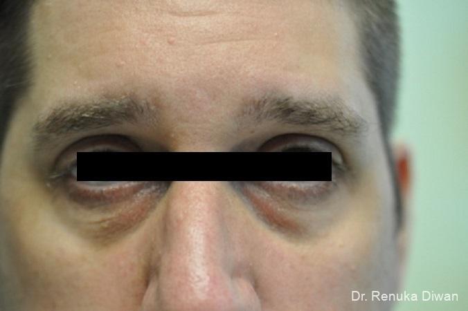 Dark Circles: Patient 1 - Before 