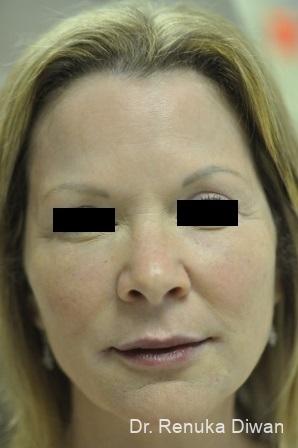 Non-Surgical Facelift: Patient 2 - After  