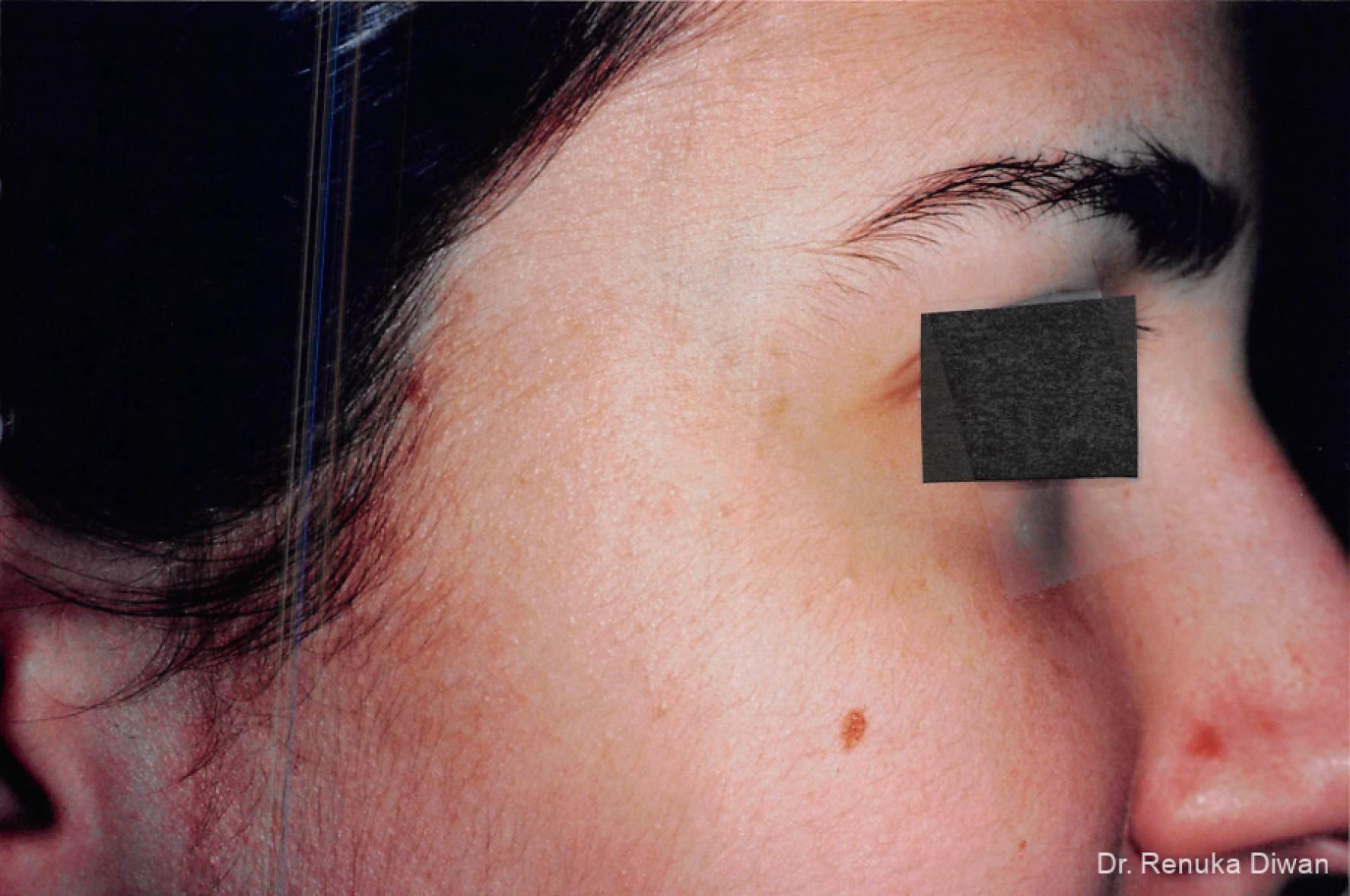 Lasers For Brown Spots: Patient 1 - After  