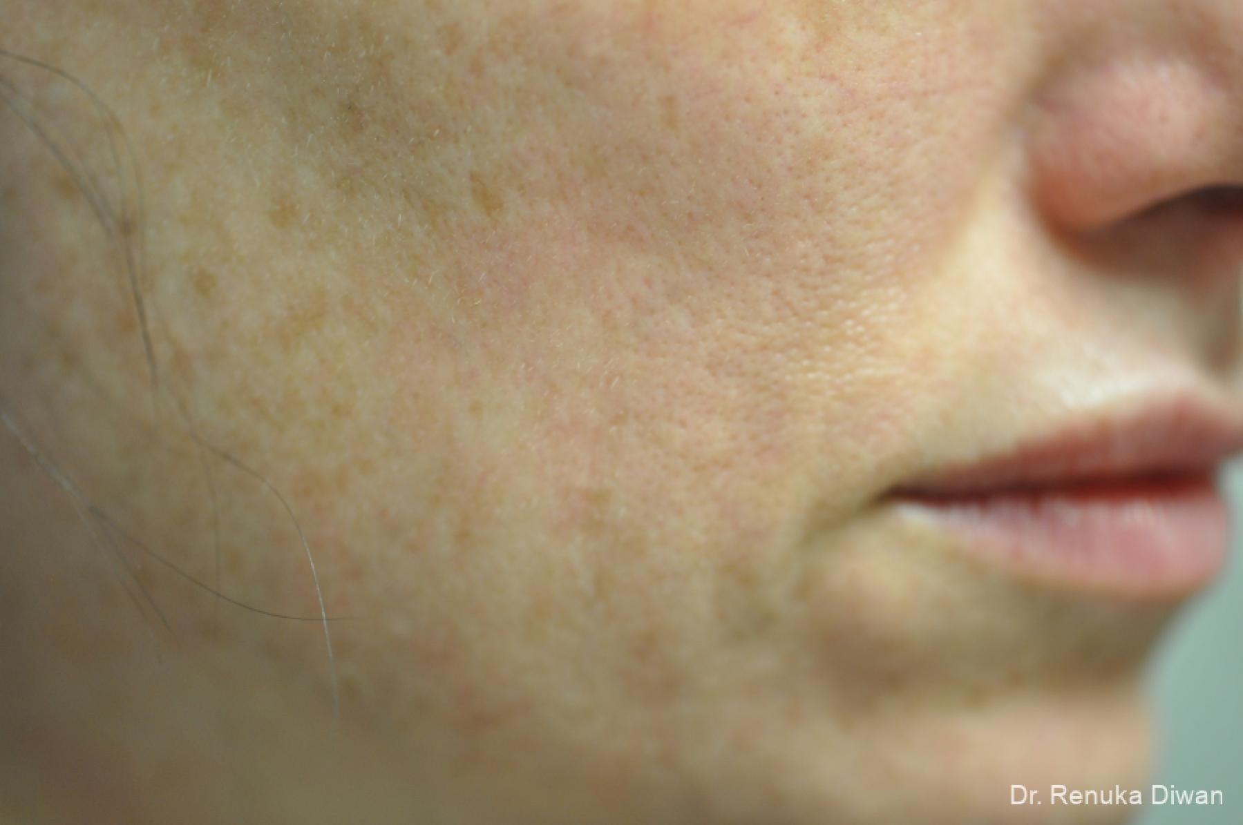 Laser For Veins And Redness: Patient 35 - After 1