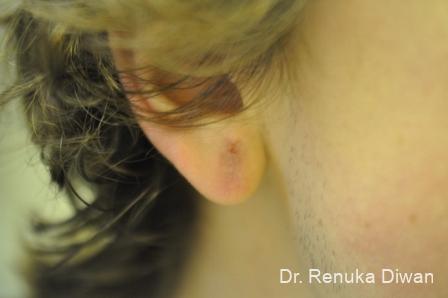 Earlobe Surgery: Patient 8 - After 1