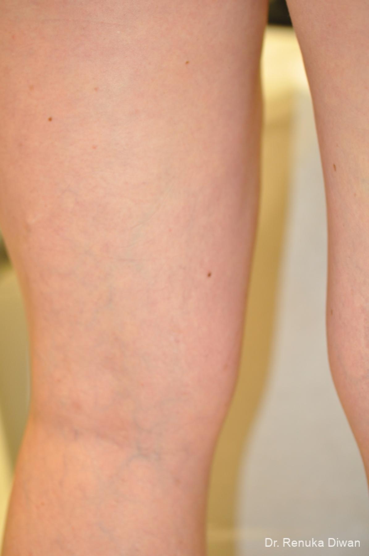 Veins On Legs: Patient 5 - After 2