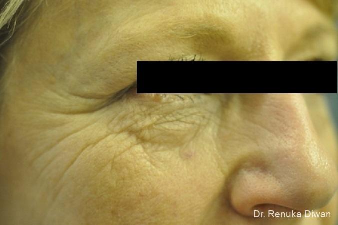 Microneedling: Patient 1 - Before and After 2