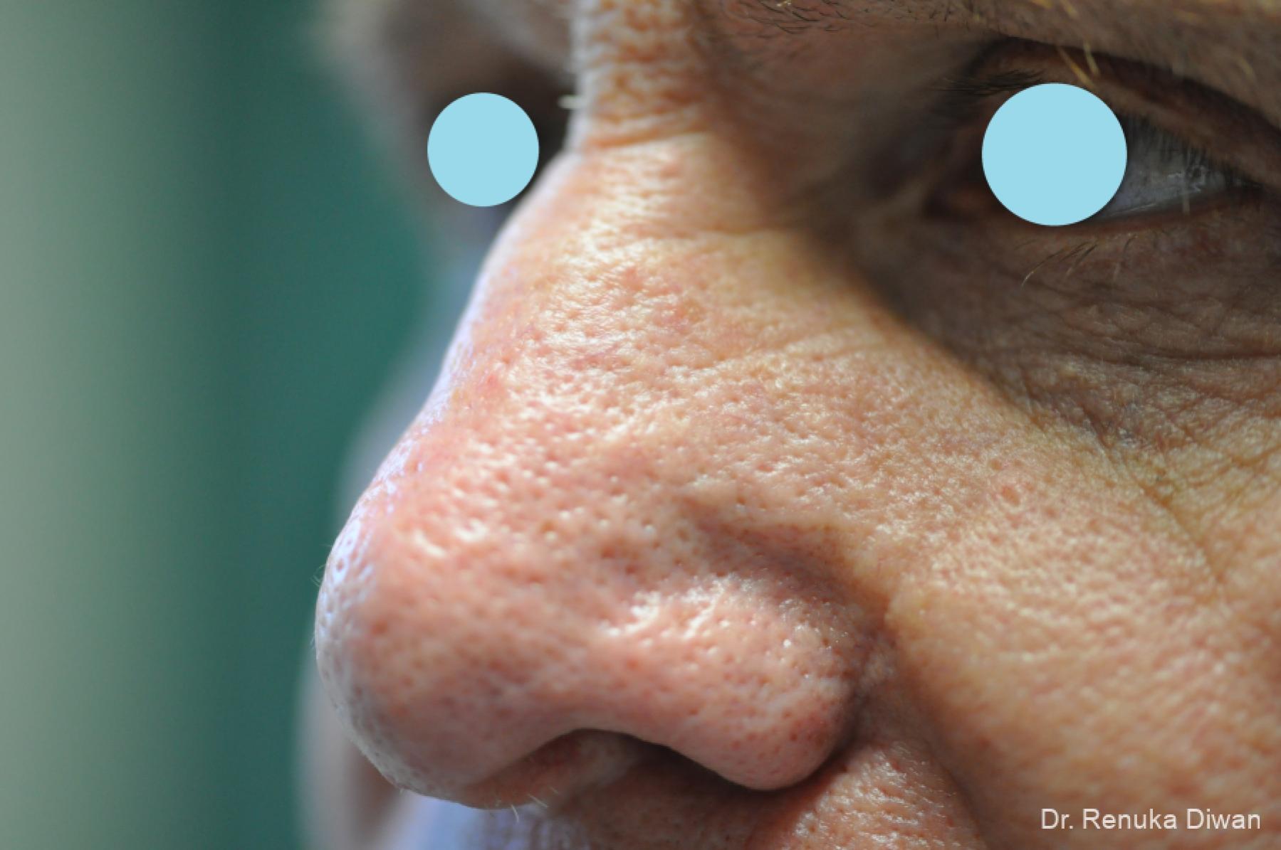 Lasers For Rhinophyma: Patient 5 - After 3