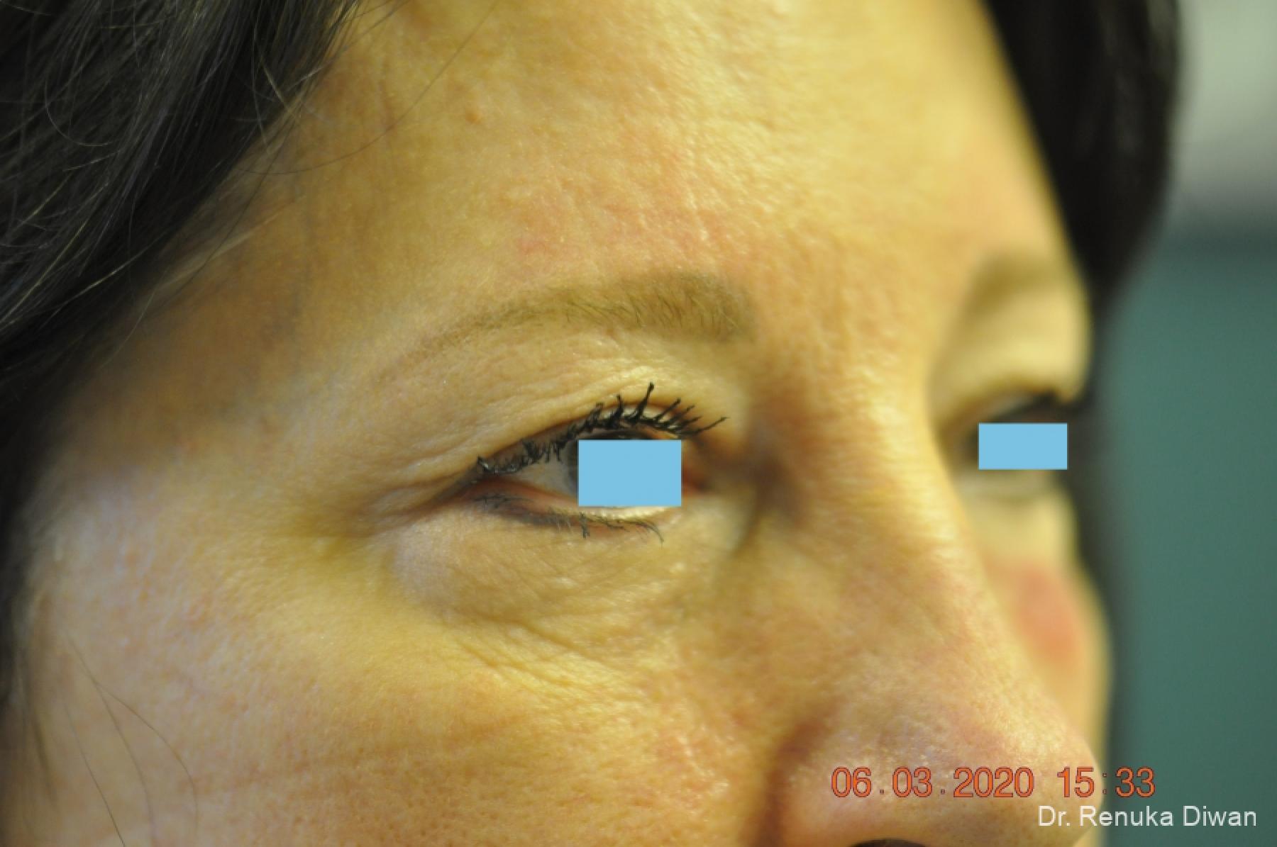 Blepharoplasty: Patient 3 - Before 2