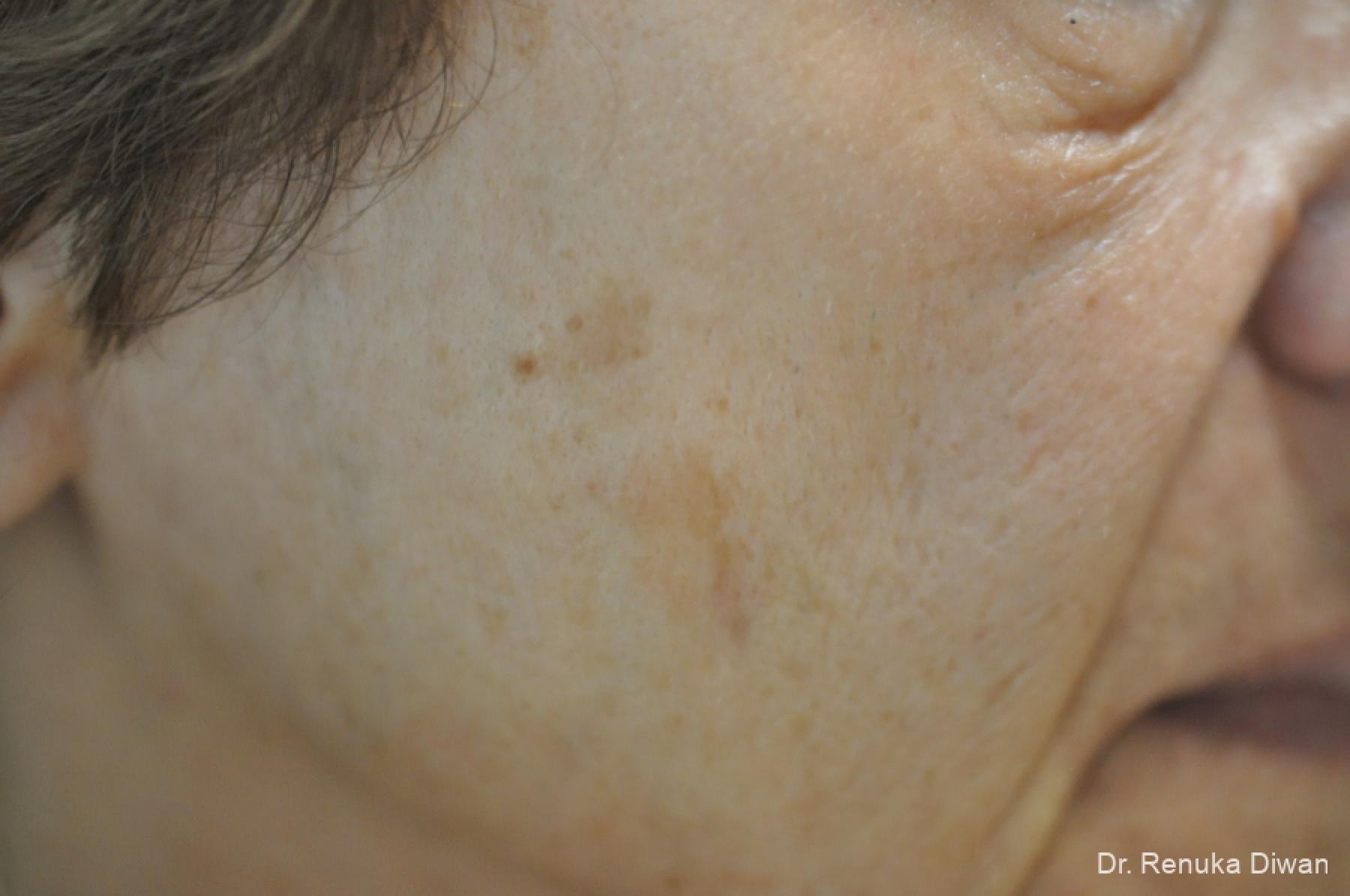 Lasers For Brown Spots: Patient 15 - Before 1
