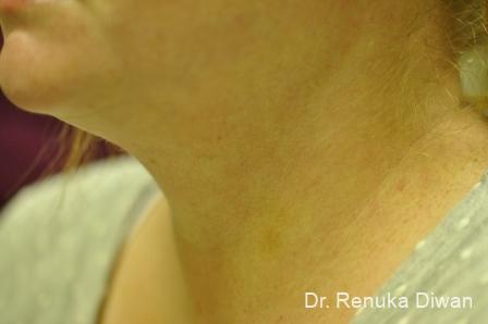 Neck Creases: Patient 1 - After 2