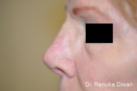 Non-Surgical Rhinoplasty: Patient 1 - After 2