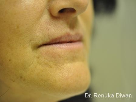 Lips And Mouth: Patient 11 - After 1