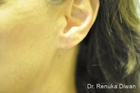 Earlobe Surgery: Patient 2 - After  