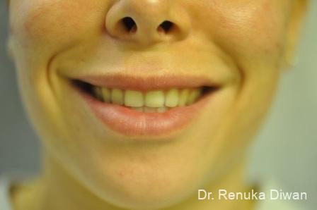 Smile Lines: Patient 10 - Before 
