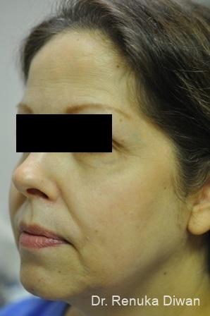 Skin Tightening: Patient 1 - Before 