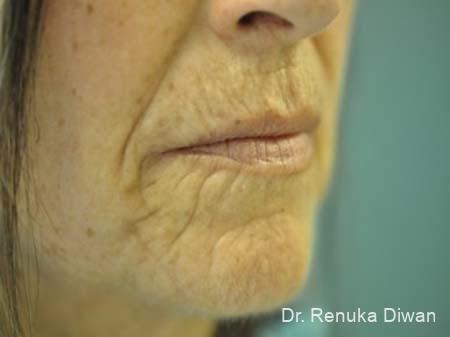 Lips And Mouth: Patient 8 - Before 1