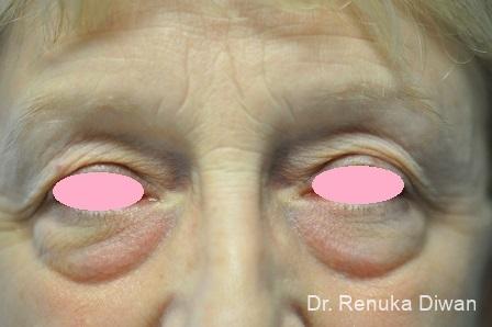 Blepharoplasty: Patient 12 - Before 1