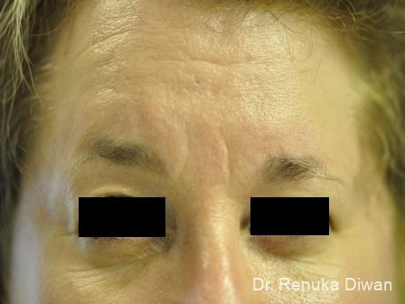 BOTOX® Cosmetic: Patient 6 - Before 1