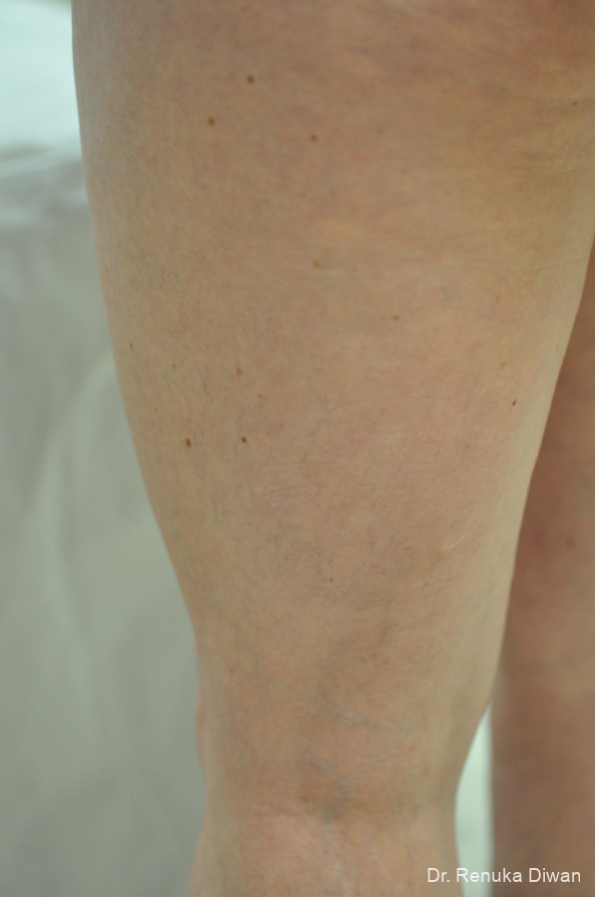 Veins On Legs: Patient 5 - After  