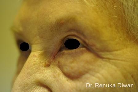 Blepharoplasty: Patient 10 - After  