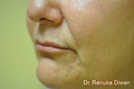 Lips And Mouth: Patient 17 - Before and After 2